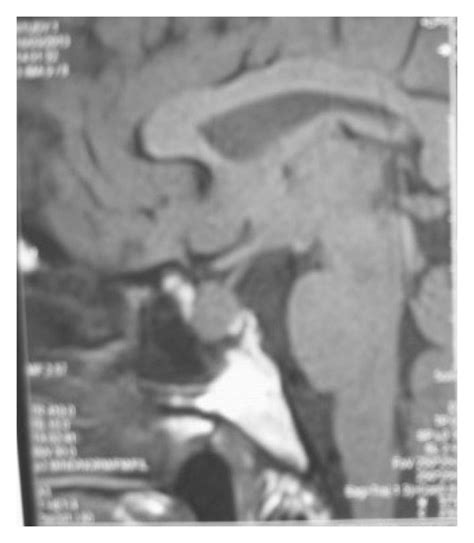 Preoperative Pituitary Mr Images T1 Weighted Contrast And Sagittal