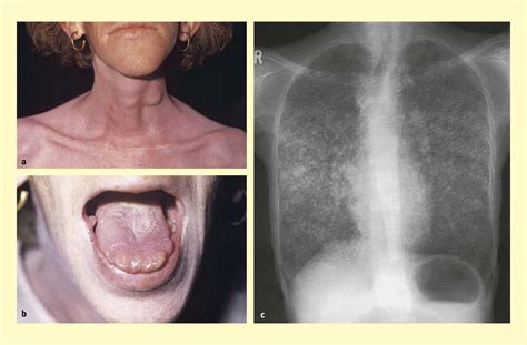 Multiple Endocrine Neoplasia Medicine