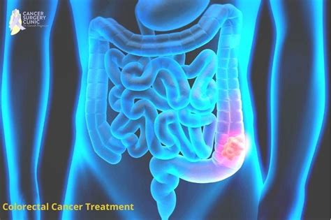 Colorectal Cancer Treatment In Mumbai Dr Ganesh Nagarajan Medium