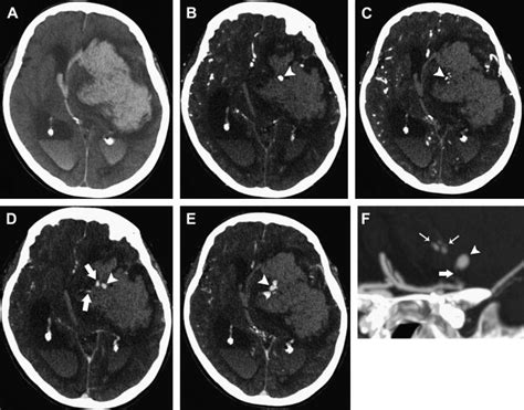 Hemorrhagic Cva Ct Scan Ct Scan Machine Images