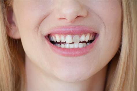 Hipoplasia dental en adultos y niños causas y tratamiento