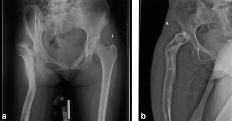 Anteroposterior A And Lateral B Right Hip Radiographs Of Our