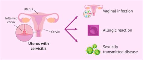 How is cervicitis cured?