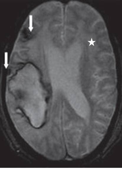 Cerebral Amyloid Angiopathy MRI