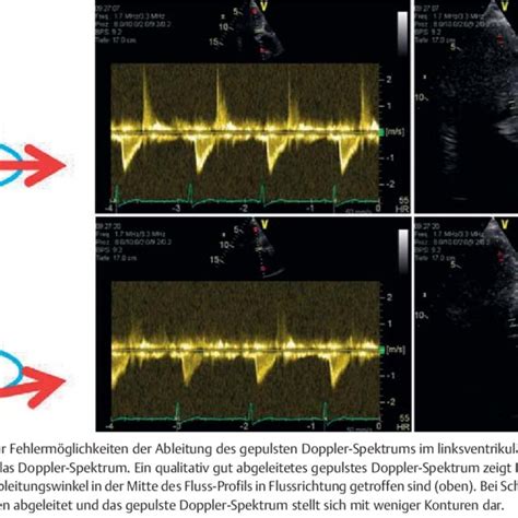 Calculation Of E E From A Correctly Derived Mitral Valve Flow Profile