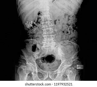 Xray Image Plain Abdomen Stock Photo Shutterstock