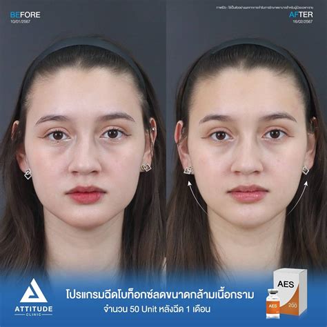 รีวิว Attitude Clinic ห้วยขวาง รีวิวโปรแกรมฉีดโบท็อกซ์ลดขนาด