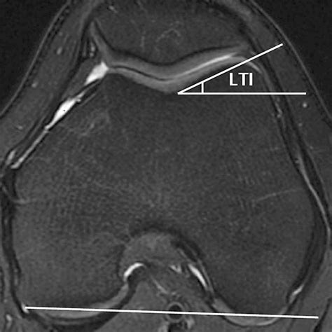 Analysis Of The Patellofemoral Region On MRI Association Of Abnormal