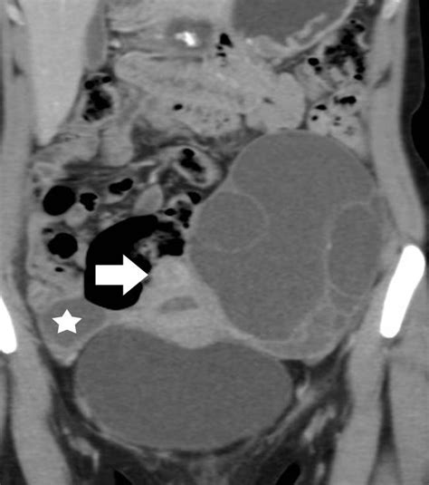 Ovarian Mucinous Cystadenoma Ct And Mr Imaging Findings Eurorad