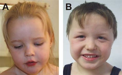 Facial Phenotype Of Patients And Consistent Facial Features Of