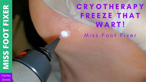 Cryotherapy Freeze That Wart Miss Foot Fixer Youtube