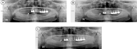 Figure 2 From A Case Of Intractable Bisphosphonate Related Osteonecrosis Of The Jaw Treated With