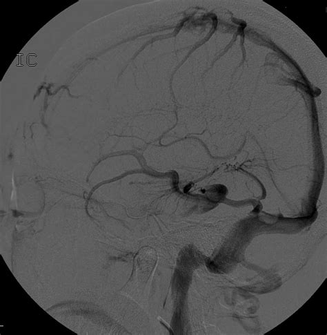 A Case Of Developmental Venous Anomaly Dva With Varix A Year Old