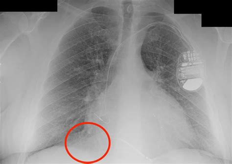 Chest X Ray In Posteroanterior View Showing The Icd In Place And The Download Scientific