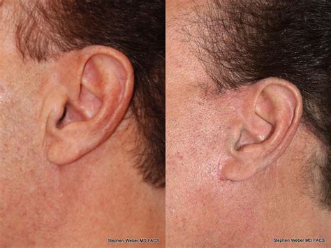 Facelift Before And After Weber Facial Plastic Surgery