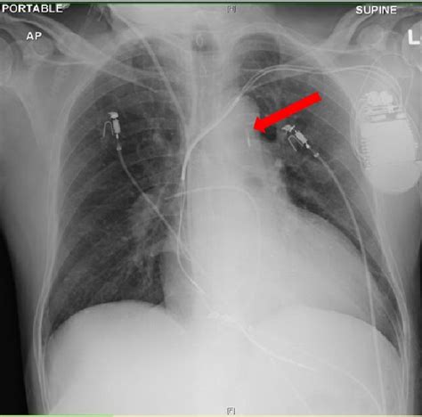 Intra Aortic Balloon Pump Chest X Ray