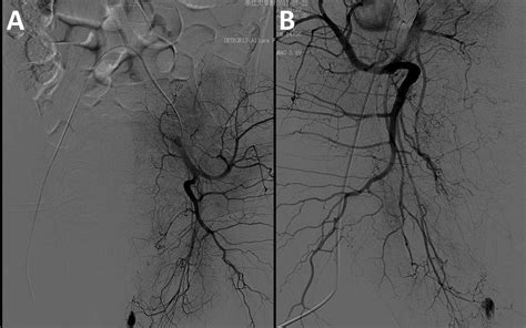 Superselective Internal Iliac Arterial Embolization For Severe