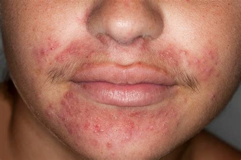 Redness Around Mouth