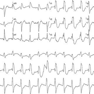 Twelve Lead Electrocardiogram In Sinus Rhythm Showing Qrs With Complete