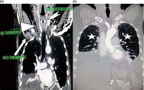 Atypical Presentation Of Lemierre Syndrome Role Of Imaging Bmj Case