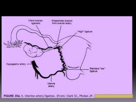 Surgical Management Of Pph At Tertiary Center