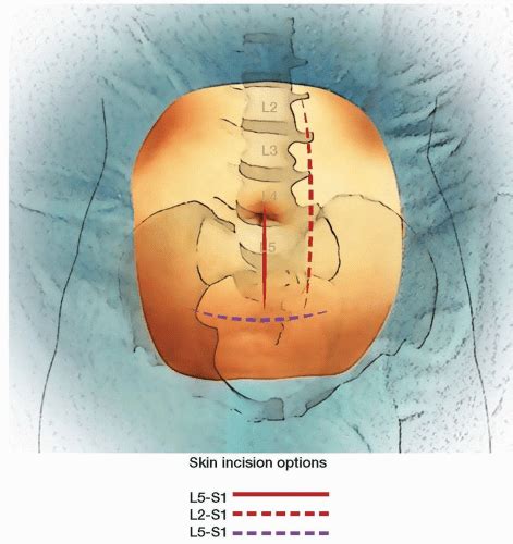 Anterior Lumbar Interbody Fusion | Musculoskeletal Key