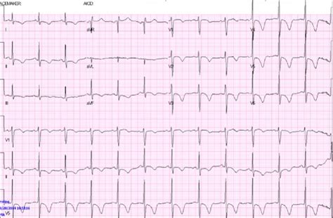 Ekg On Admission Demonstrating Normal Sinus Rhythm With St T Segment