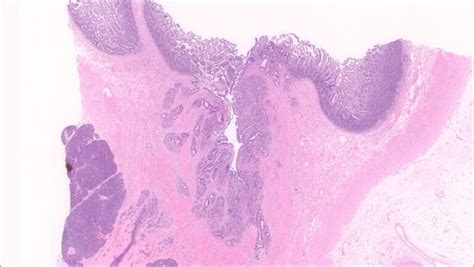 Ampulla Normal Histology Nus Pathweb Nus Pathweb