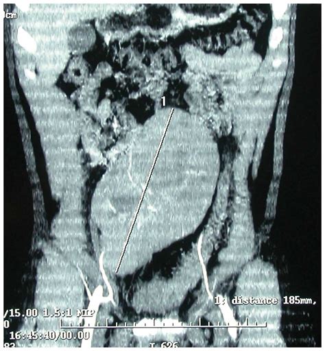 Post Orchidectomy Retroperitoneal Seminoma A Case Report