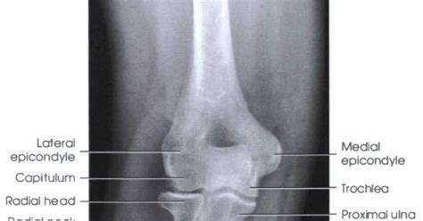 Medial Epicondylitis X Ray
