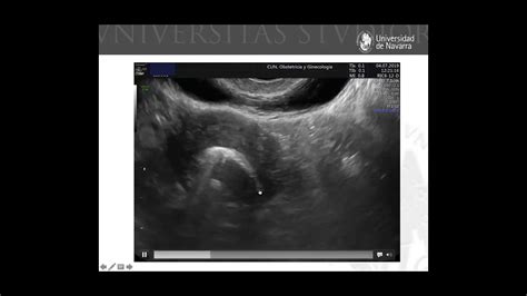 Estudio de la permeabilidad tubárica con ultrasonidos Técnica HyFoSy