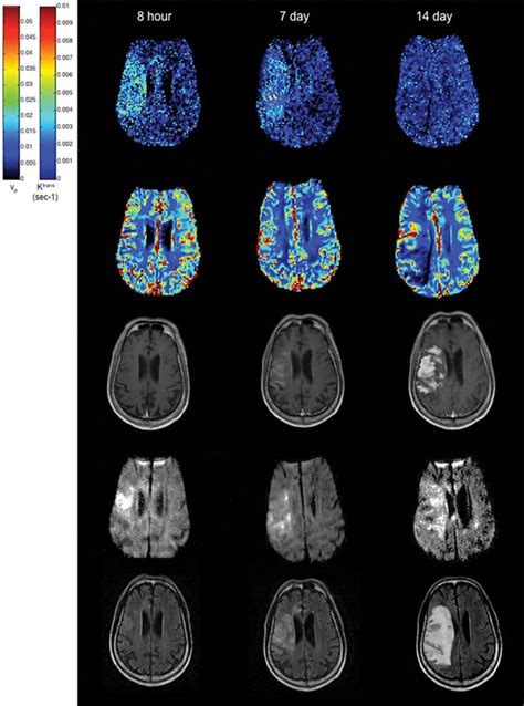 Effects Of Microvascular Permeability Changes On Contrast Enhanced T1