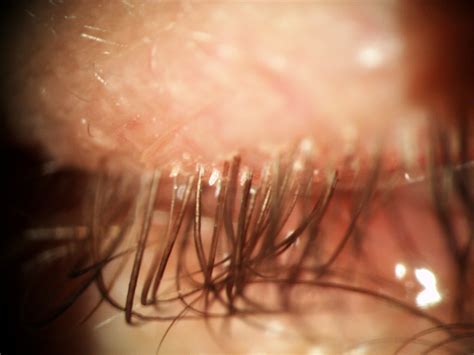 Demodex Eyelash Mites