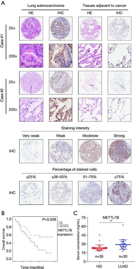 Expression Of Mettl B In Luad Tissues Compared With Adjacent Normal