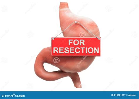 Gastric Resection Concept Human Stomach With For Resection Hanging