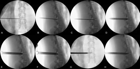 Scielo Brasil Experimental Model For Transforaminal Endoscopic