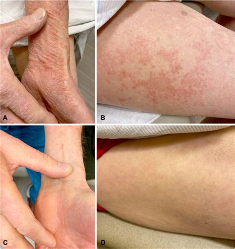 Intravenous Immunoglobulin Induced Eczematous Dermatitis Treated With