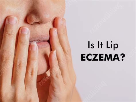 Eczema on Lips - Causes, Symptoms, Treatment & Home Remedies