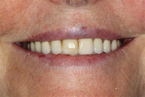 Proth Se Compl Te Amovible Prosthodontie Rive Sud Inc