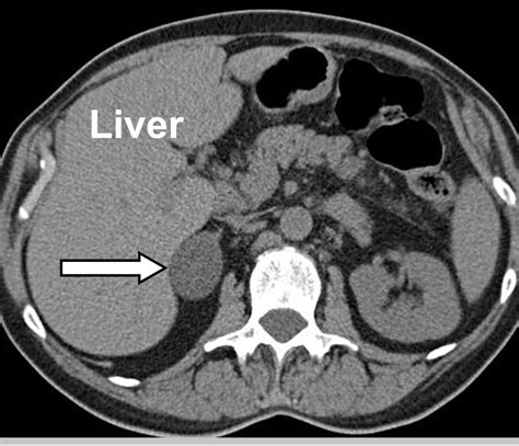 Adrenal Incidentaloma Adrenal Tumor Found By Accident