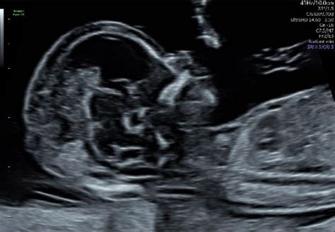 First Trimester Ultrasound | Monash Ultrasound for Women