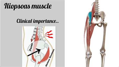 Iliopsoas Muscles Clinical Importance Anatomy Clinical Iliopsoas