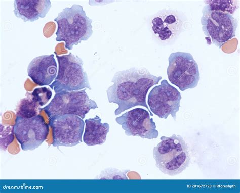 Leucemia Mieloide Acuta Con Coinvolgimento Del Sistema Nervoso Centrale