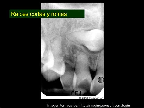 Dentinog Nesis Imperfecta Ppt Descarga Gratuita