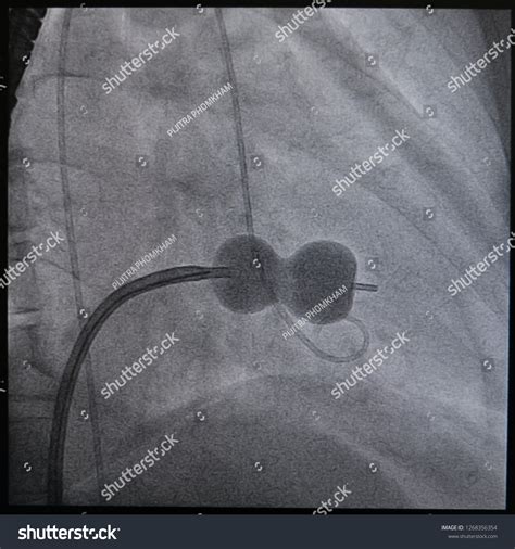 Technique Percutaneous Transvenous Mitral Commissurotomy Using Stock