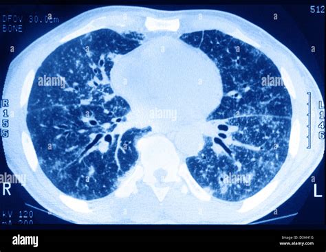 Pulmonary Tuberculosis Scan Stock Photo Alamy