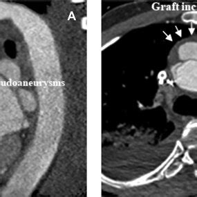 Preoperative Computed Tomography CT Scan Showing The Calcified