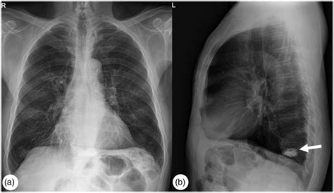 A Posteroanterior And B Lateral Chest Radiographs On Admission