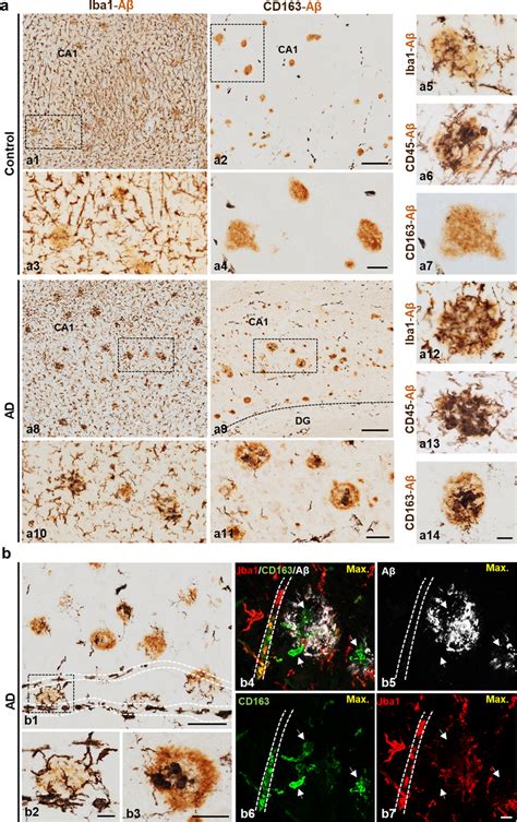 Only Abeta Plaques From AD Hippocampus Are Infiltrated With