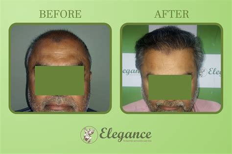 Hair Transplant Surgery In Jamnagar Gujarat India